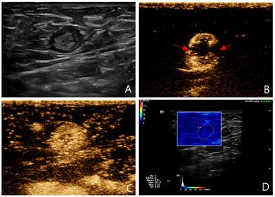 Multimodal ultrasound imaging: a method to improve the accuracy of sentinel lymph node diagnosis in breast cancer